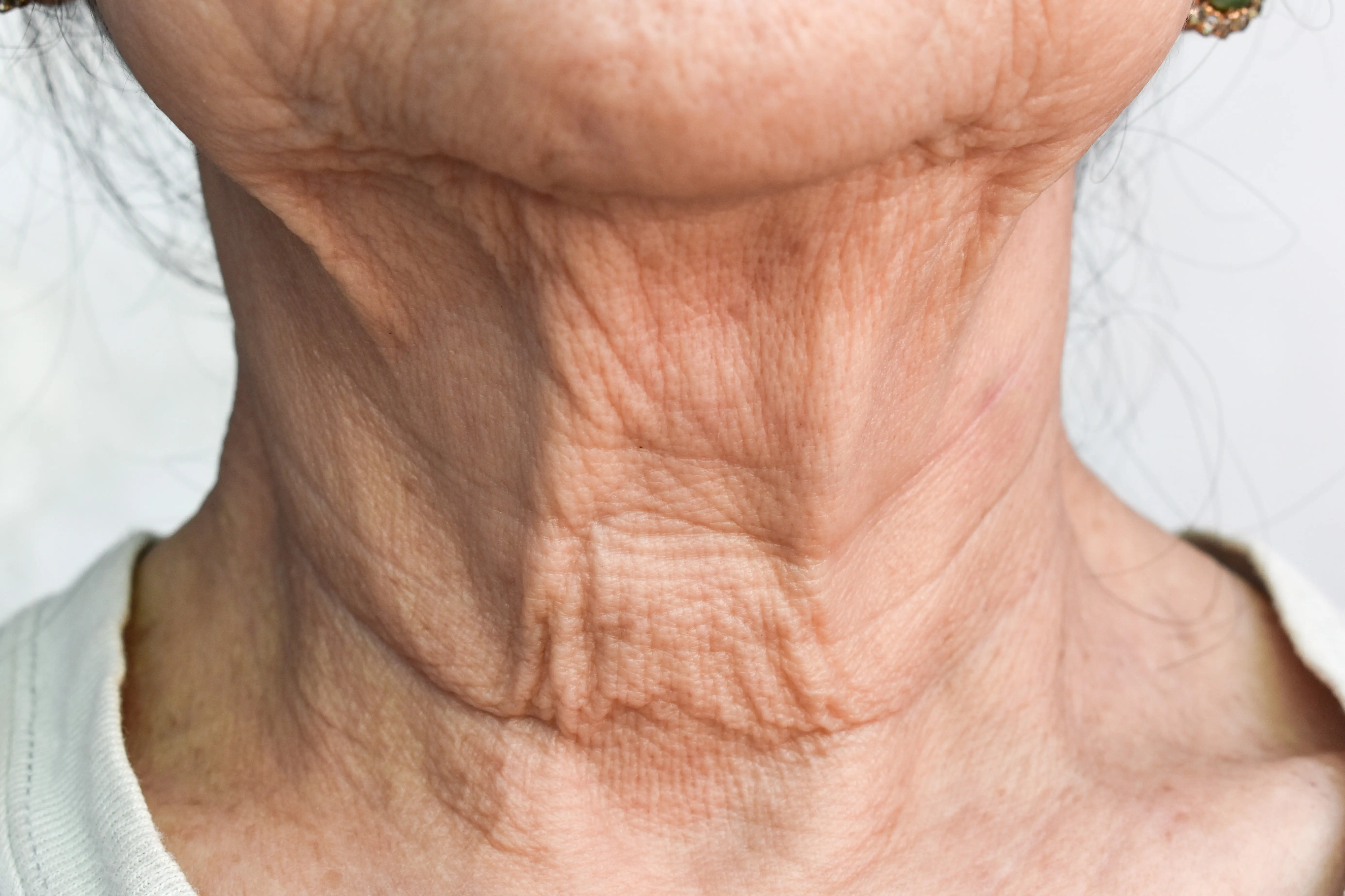 Aging skin folds or skin creases or wrinkles at neck of Asian old woman.